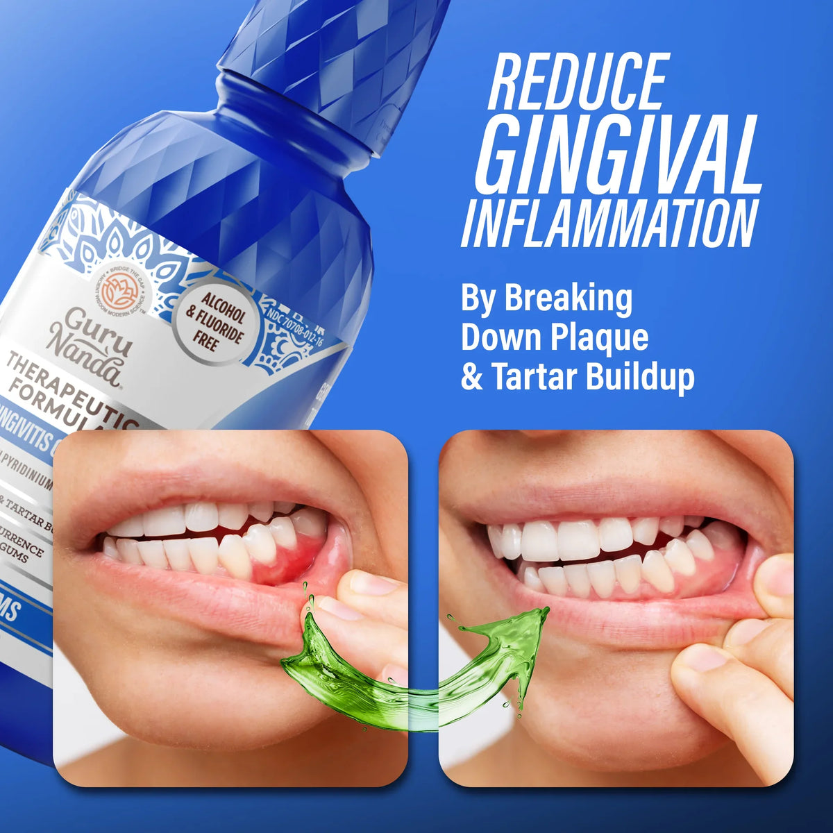 GuruNanda Healthy Gums Anti-Gingivitis Oral Rinse before and after results, reducing gingival inflammation by breaking down plaque and tartar buildup.